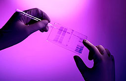 Gen aumenta el riesgo de desarrollar esclerosis lateral amiotrófica