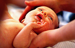 Prematuros tienen más posibilidades de sufrir hemangiomas
