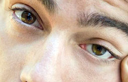 Niveles de ECP determinan severidad de la queratoconjuntivitis atópica