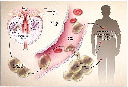 metastatic cancer de prostata