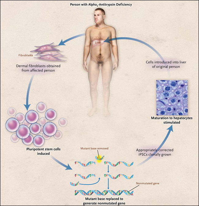 Figura 1: aminorando la deficiencia de alfa1-antitripsina