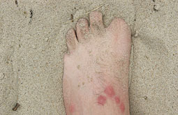 A combatir las picaduras de insectos y artrópodos