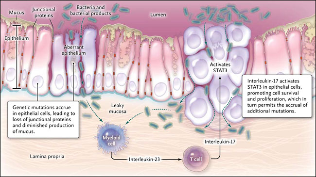 Figura 1: modelo inflamatorio para la iniciación del cáncer colorrectal