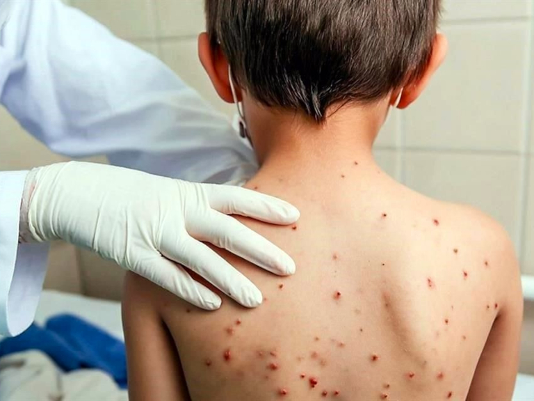 red mundial, sarampión, oms