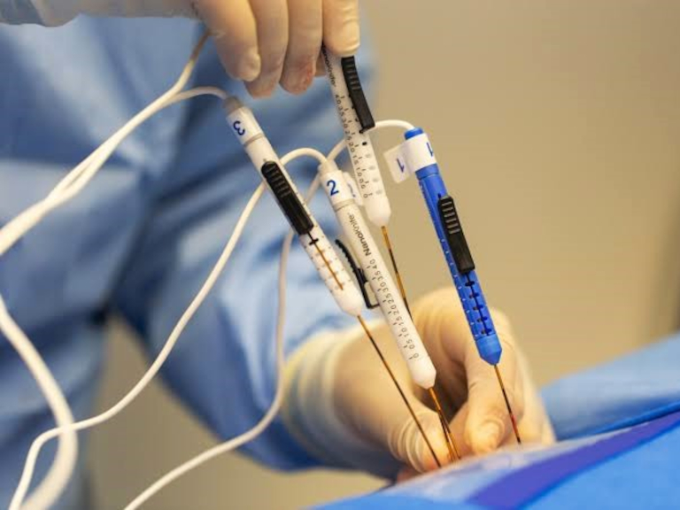 clectroporación irreversible, hospital regional de concepción, oncología, radiología