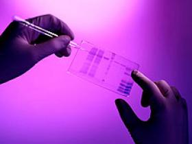 Gen aumenta el riesgo de desarrollar esclerosis lateral amiotrófica