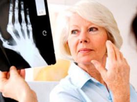 Resultado de imagen para diagnostico de la artritis reumatoide
