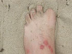 A combatir las picaduras de insectos y artrópodos