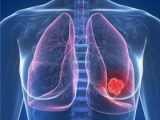 Osimertinib  es efectivo contra el cáncer pulmonar