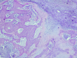 Aplicación innovadora de machine learning en el osteosarcoma