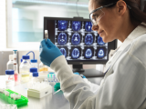 Avances terapéuticos con anticuerpos monoclonales en alzhéimer