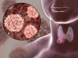 Terapia dirigida contra cáncer medular de tiroides