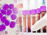 Enfoque prometedor en el tratamiento de la leucemia linfocítica crónica