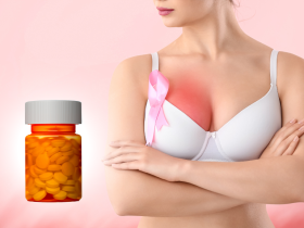 Ácido acetilsalicílico no aporta como adyuvante en cáncer de mama