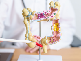 Inmunoterapia neoadyuvante para frenar el cáncer de colon localizado
