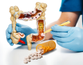 cáncer colorrectal, ácido acetilsalicílico, recurrencia de cáncer colorrectal
