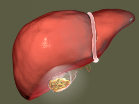 colelitiasis, cálculos biliares, prevalencia de colelitiasis