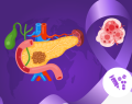 cáncer de páncreas, adenocarcinoma ductal pancreático,remisión del cáncer de páncreas 