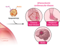 colesterol de lipoproteínas de baja densidad, LDL-C, colesterol LDL, hipercolesterolemia, prevención de la enfermedad cardiovascular aterosclerótica, aterosclerosis, edición de bases de ADN in vivo