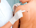 fotofinder, dermatologia, hospital clinico universidad de chile, IA, melanomas