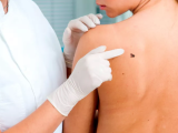 fotofinder, dermatologia, hospital clinico universidad de chile, IA, melanomas