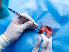 trasplante hígado, dispositivo, función hepática, trasplante hígado