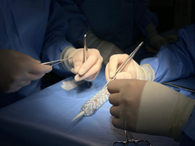 reparación híbrida del arco aórtico, síndrome aórtico agudo, cardiocirugía, cirugía endovascular, hospital de la serena