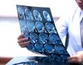 accidente cerebrovascular, neurología, región biobío, ACV