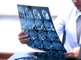 accidente cerebrovascular, neurología, región biobío, ACV