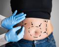 exceso de piel, flacidez abdominal, cirugía bariátrica, nueva clínica cordillera, abdominoplastía