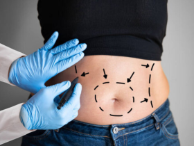 exceso de piel, flacidez abdominal, cirugía bariátrica, nueva clínica cordillera, abdominoplastía