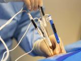 clectroporación irreversible, hospital regional de concepción, oncología, radiología