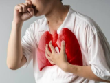 COVID-19 grave eleva el riesgo de desarrollar tuberculosis