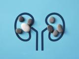 bacterias, cálculos renales, investigación